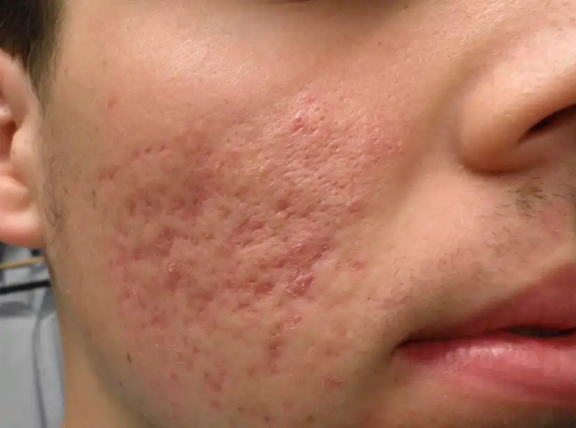 Acne-Scars