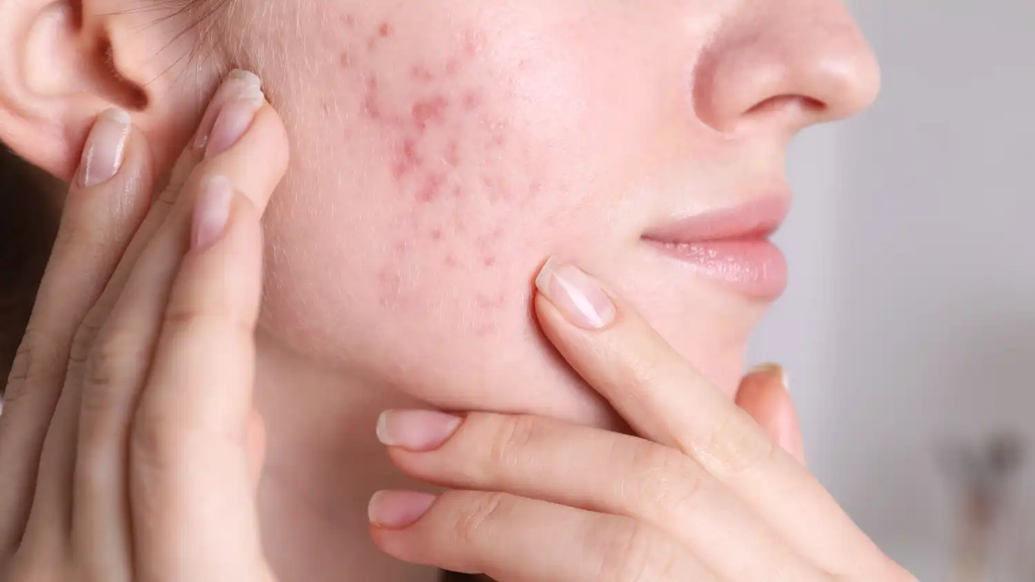 Acne-mild