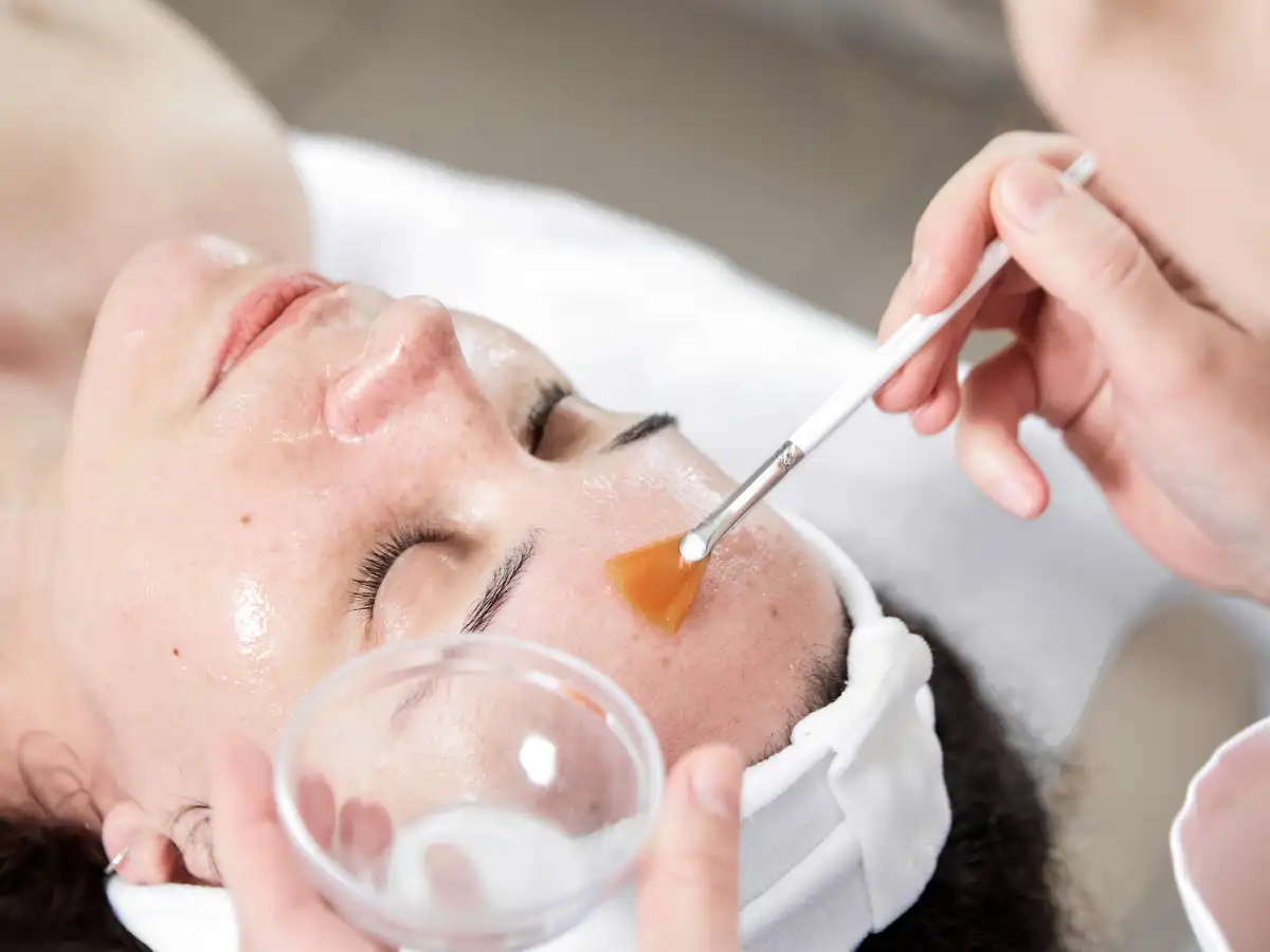 Chemical-Peel