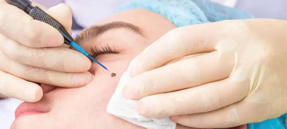 Electrocautery
