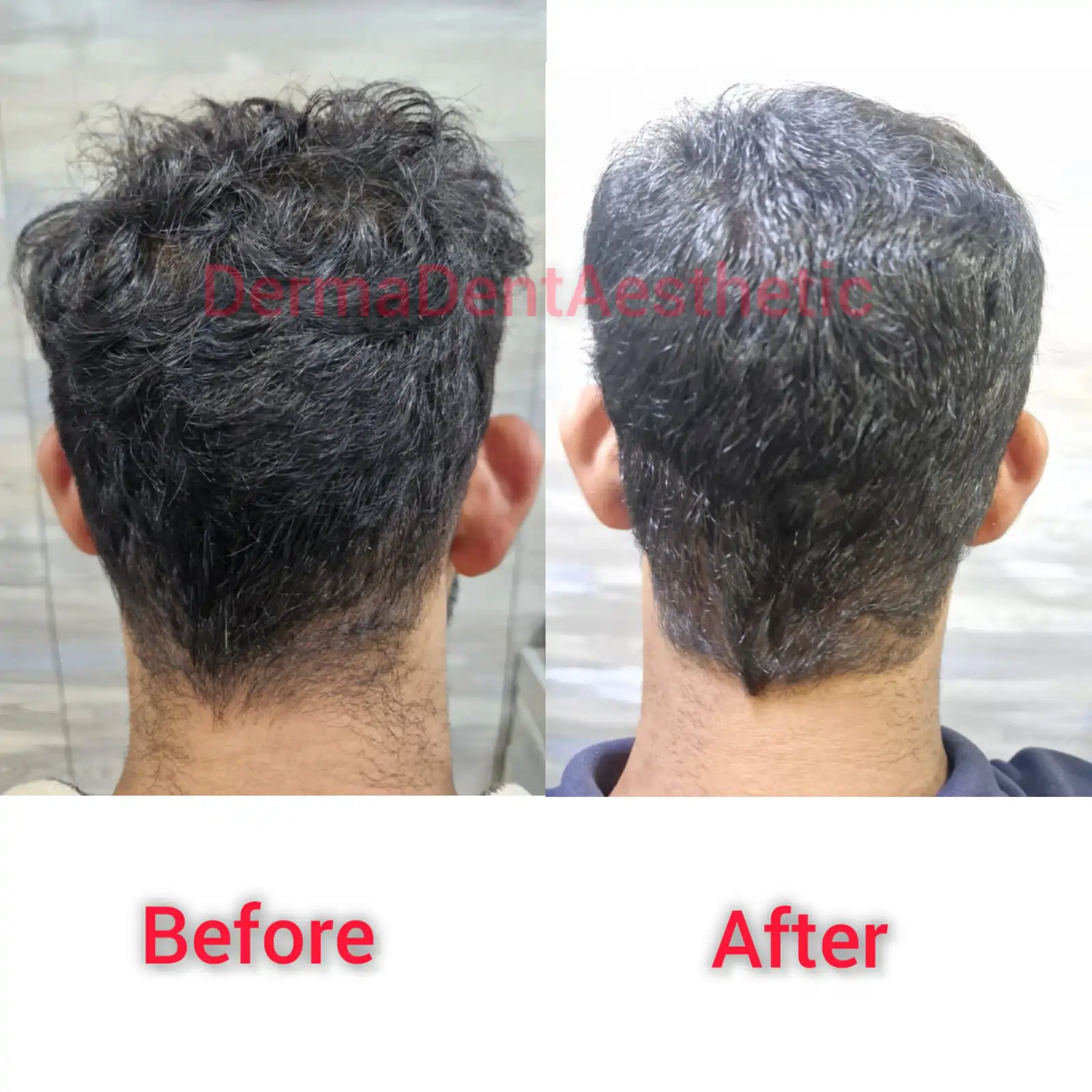Hair-Loss