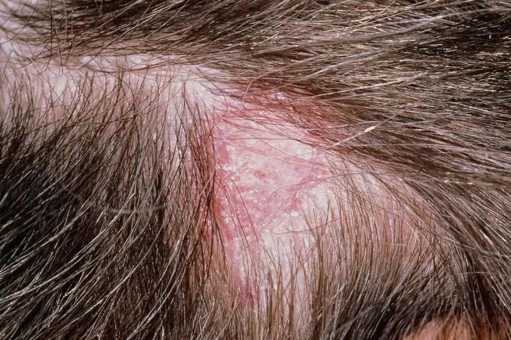HairInfections