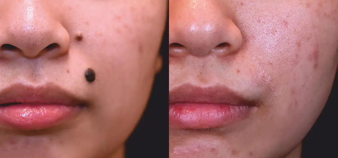 Mole-Removal