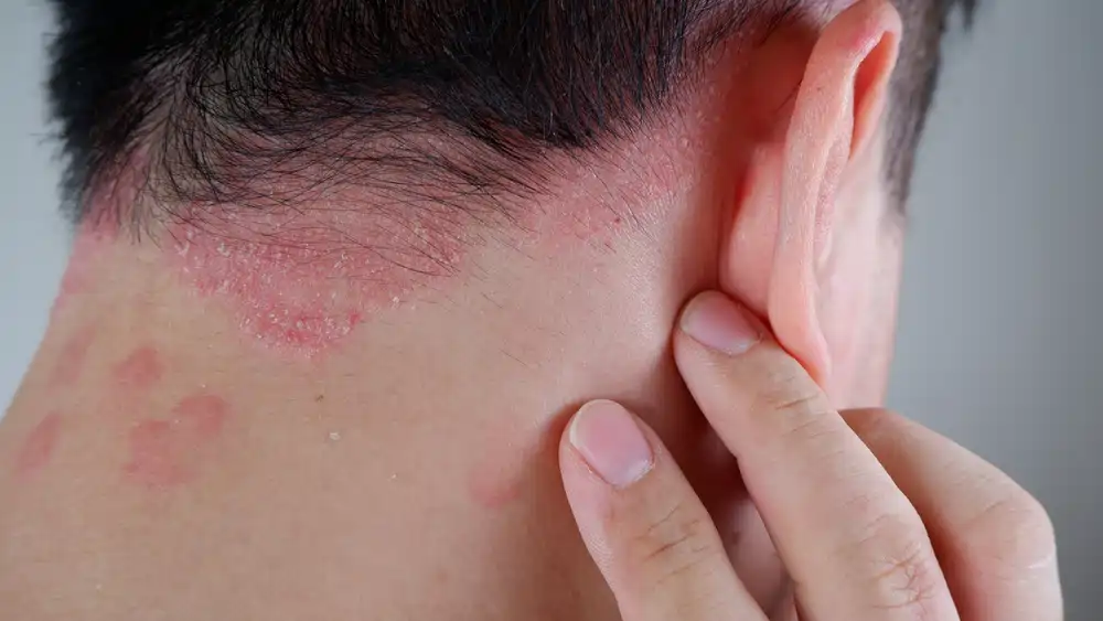 Psoriasis