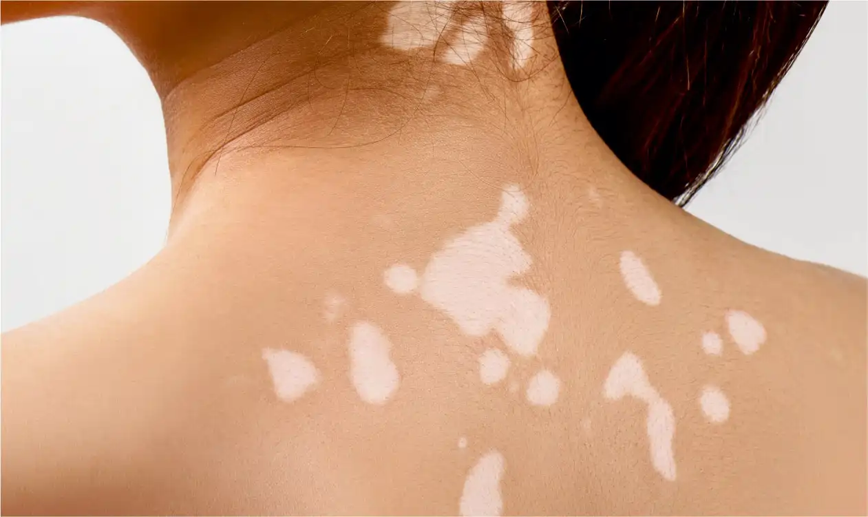 Vitiligo-Surgery