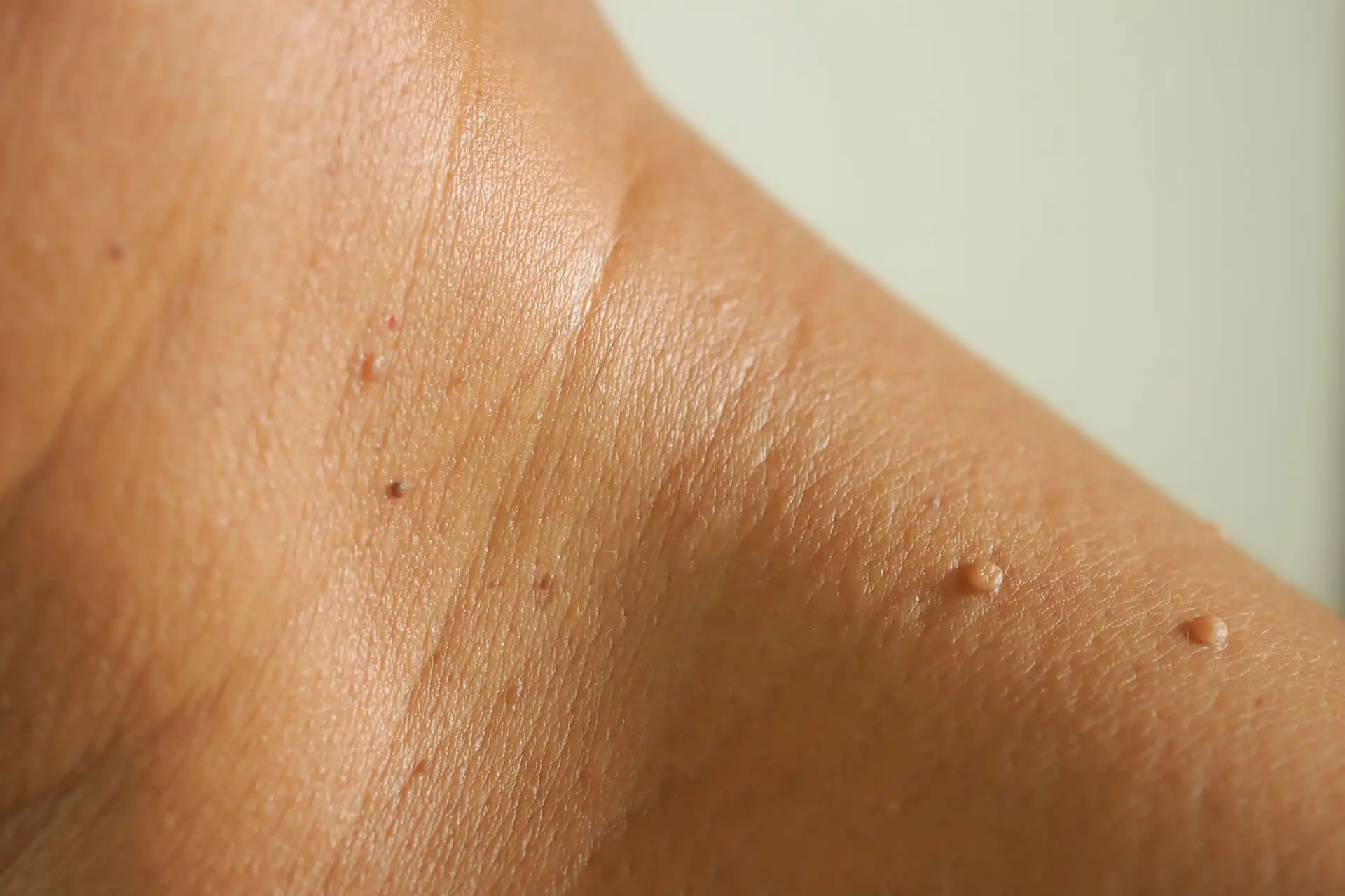 skin-tag-removal